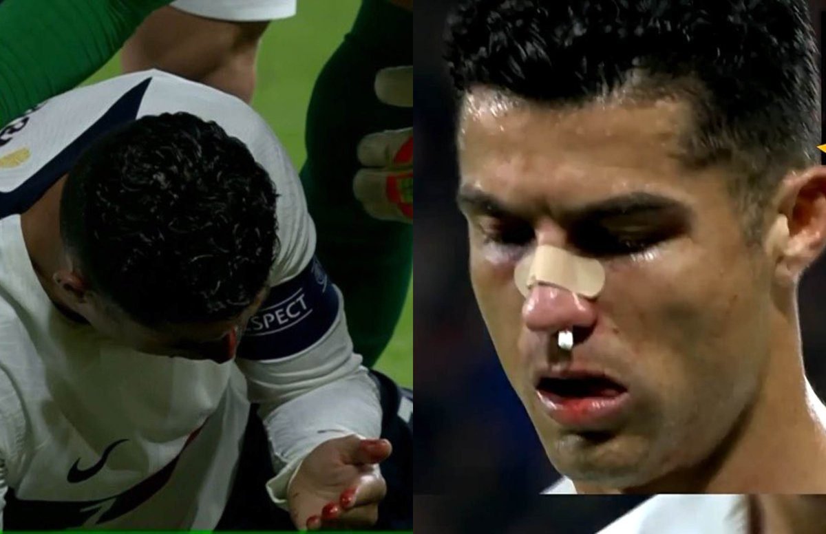 | رونالدو يتعرض لإصابة قوية خلال مباراته أمام التشيك في دوري الأمم الأوروبية